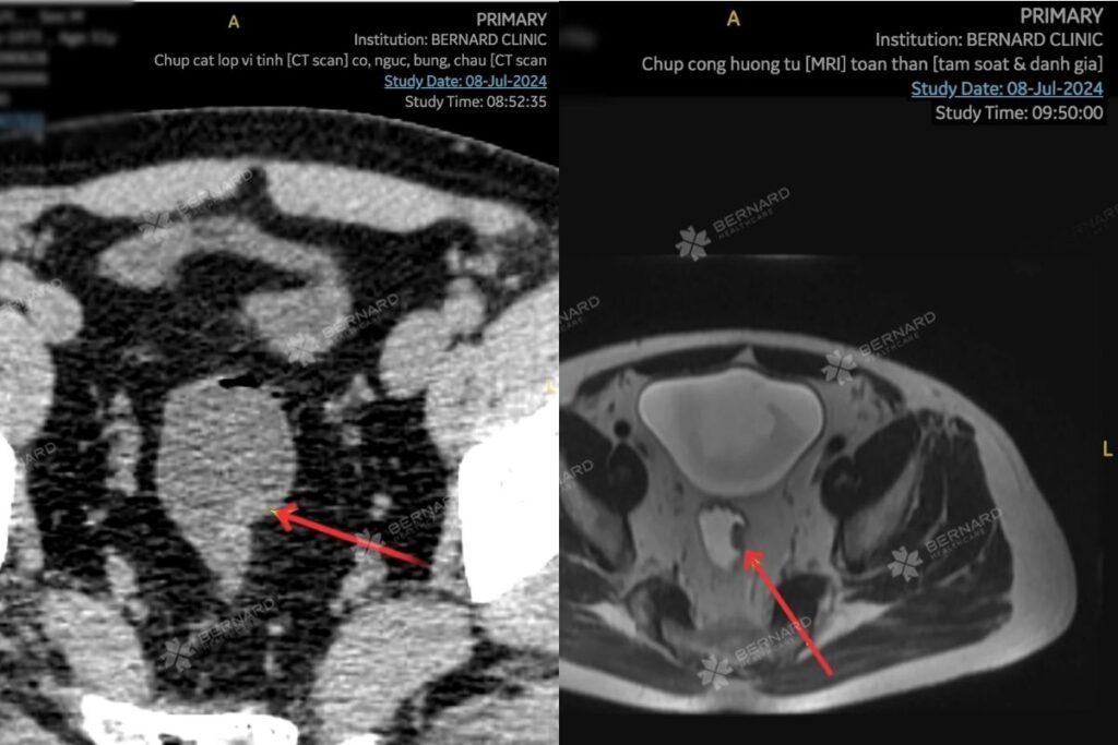 Ung thư đại tràng